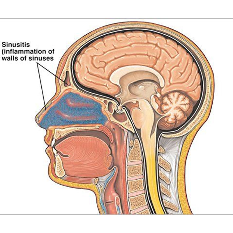 تشخیص بیماری بینی